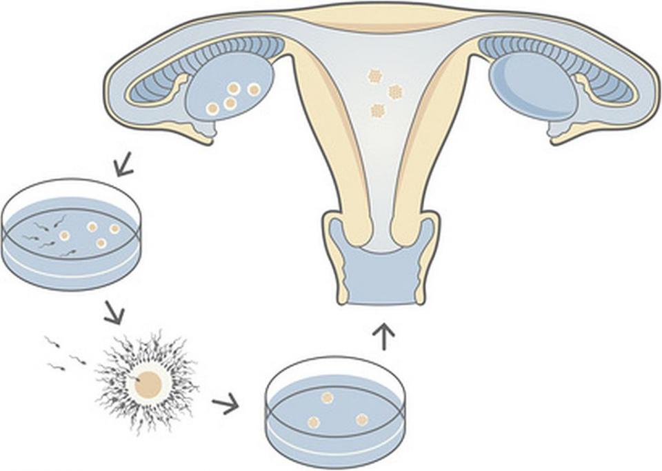 In vitro fertilization IVF md