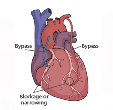 coronary artery bypass